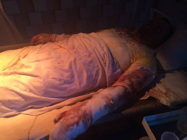 Путинское зверье два часа допрашивало обгоревшего на 75% десантника