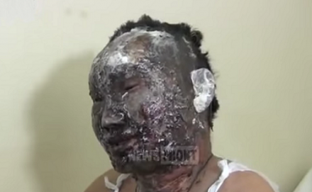 Бурятский «герой новороссии» не дождался от властей РФ помощи на лечение