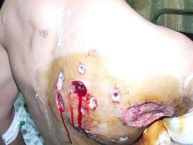 Українських бійців закидали боєприпасами, що спричиняють болісну та повільну смерть