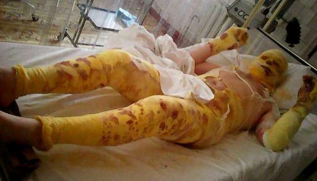 Некачественная солдатская форма ВСУ расплавилась прямо на бойцах – волонтер