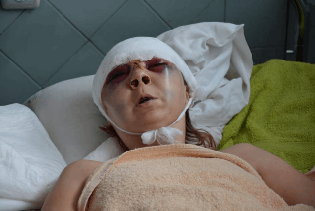 В сети показали фото зверски избитой в Киеве волонтерки