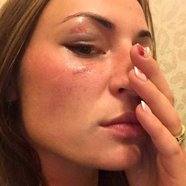 В Киеве жестоко избили телеведущую, пытавшуюся заступиться за девушку: опубликованы фото