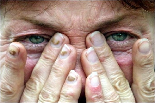 Волонтер, которого жестко избили, пришел в себя после «сна» в две недели