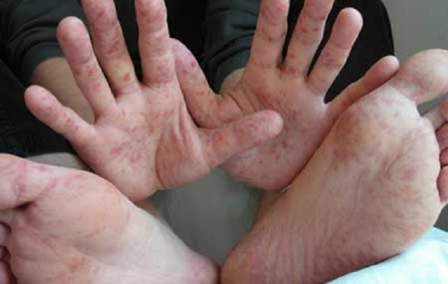 Более 500 российских туристов подхватили в Турции вирус Коксаки