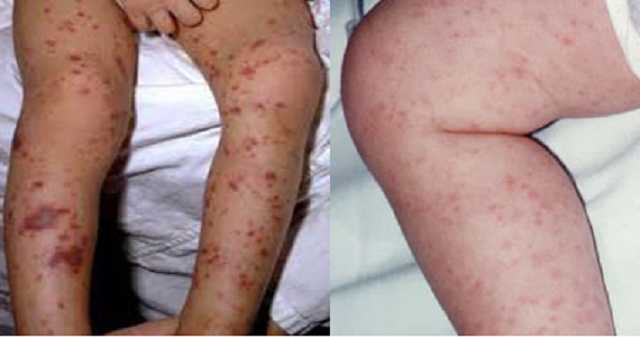 Во Львовской области вспышка менингита, госпитализировано 5 детей