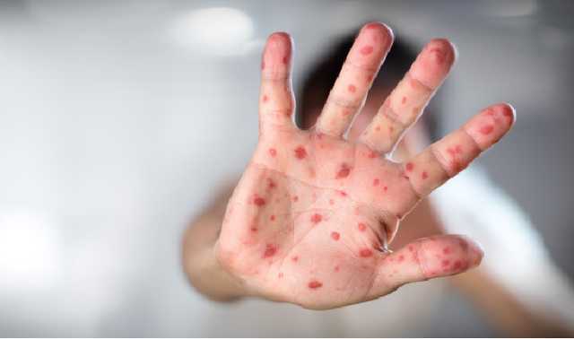 Пять человек уже умерли. Заболеваемость корью в Украине выросла в 43 раза