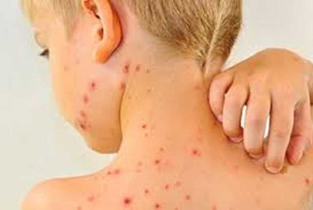 На Львовщине 38 работников предприятия госпитализированы с корью