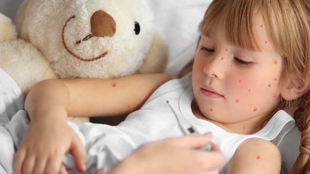 На Закарпатье корью за месяц заболели около 200 человек