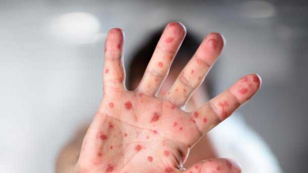 В Одесской области от осложнений кори умер ребенок