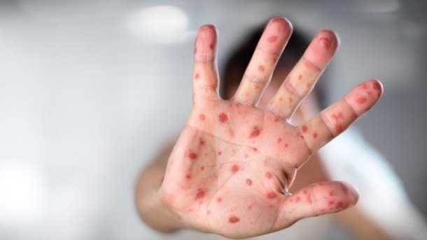 Вспышку кори зафиксировали в Донецкой области