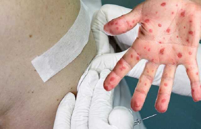 Среди умерших от кори были ВИЧ-инфицированные