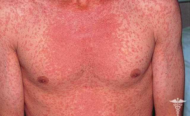 На Одещине обнаружен агрессивный генотип вируса кори, приводящий к летальности