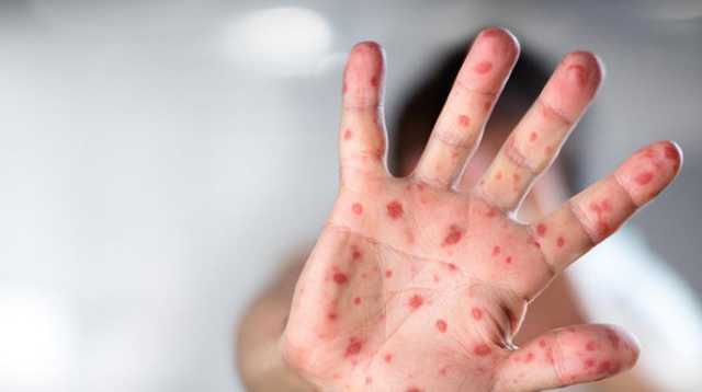 Минздрав подтвердил еще одну смерть от кори