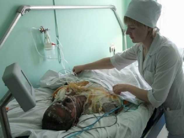 Запорожский железорудный комбинат бросил обожженных шахтеров на произвол судьбы