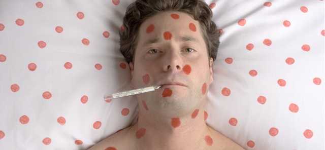 На Киевщине госпитализировали с ветрянкой и корью 11 человек