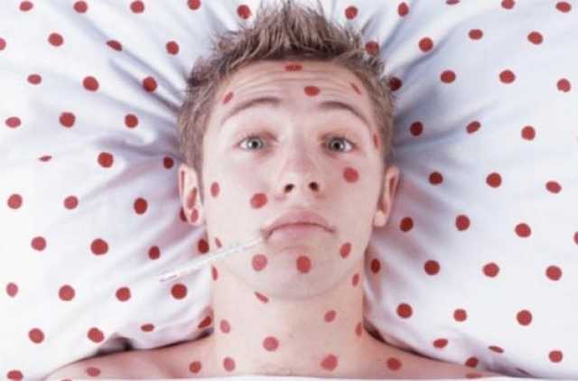 Во Львове корь атаковала студентов колледжа