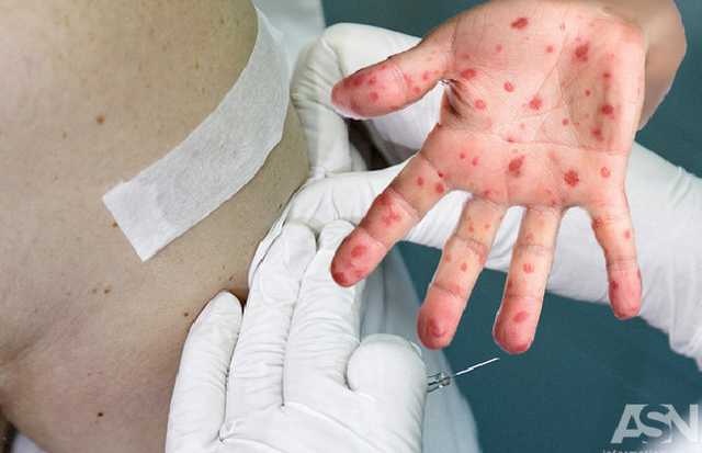 Несмотря на рапорты Минздрава, количество заболевших корью не уменьшается - эксперт