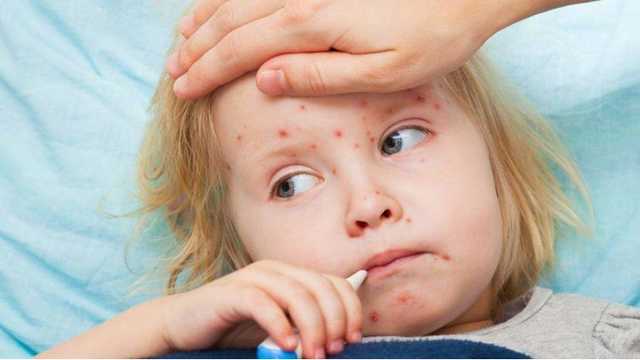 Вспышка кори: За неделю заболели более 1400 украинцев