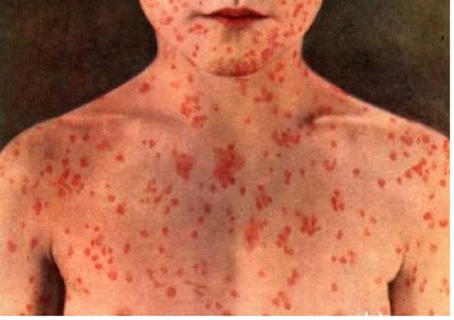 Вспышка кори в Украине: число заболевших увеличилось