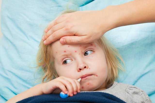 В детском лагере Бердянска зафиксирована вспышка кори