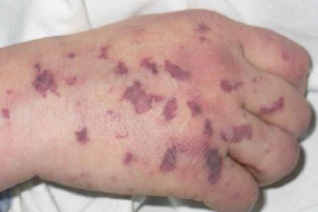 На Закарпатье из-за смертельной инфекции объявлен карантин