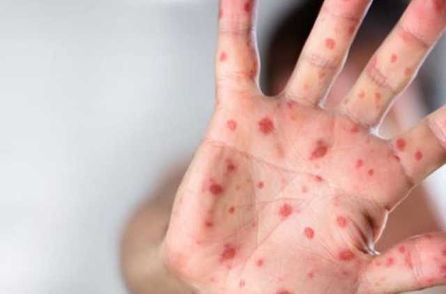 У селі на Буковині кір «косить» дітей