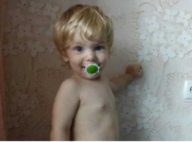 В Запорожье на двухлетнего малыша опрокинулась кастрюля с кипятком