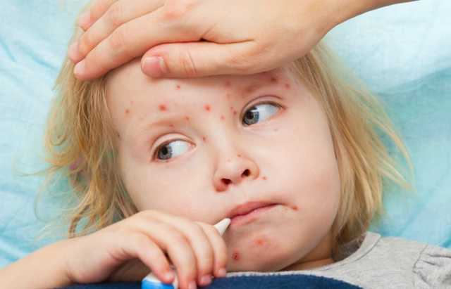 Эпидемия кори в Украине: врачи предупредили о возможности нового “рекорда”
