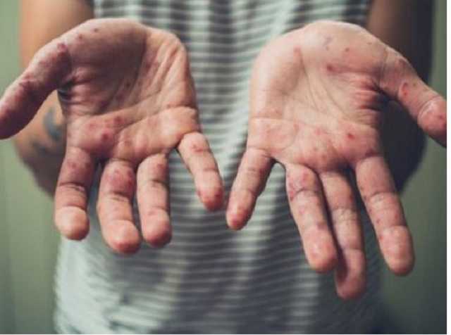 Вспышка кори: на Западной Украине значительно увеличилось число заболевших корью