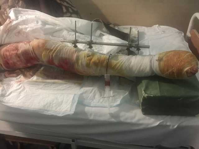 ’’Ситуация очень тревожная!’’ В Киев доставили новый борт с тяжелоранеными бойцами