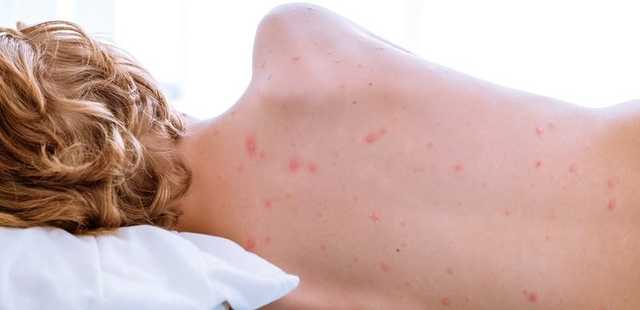 Заболеваемость корью в Украине достигла рекордного уровня за годы независимости