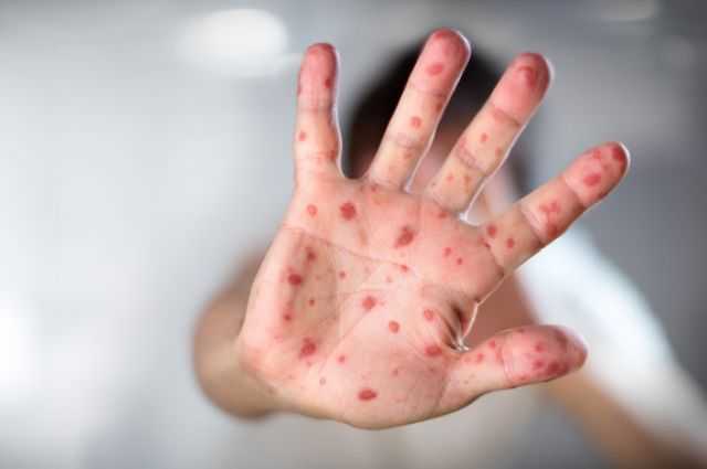 Украина поставила антирекорд по заболеваемости корью в 2018 году