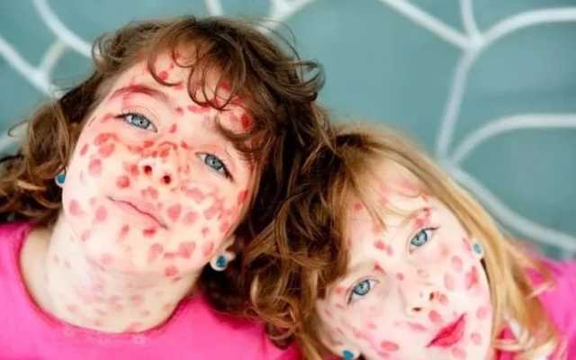 С начала года корью заболели более 2 тысяч украинцев, - Минздрав