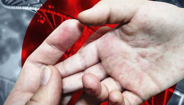 В Николаеве вспышка кори в школе-интернате - госпитализированы уже 13 человек