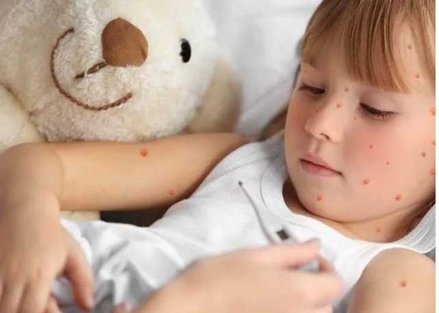 Во Львове пятеро младенцев заболели корью сразу после рождения