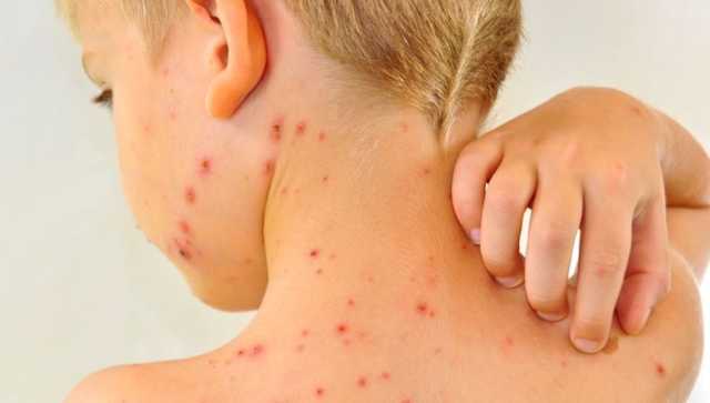 В Одесской области продолжает расти количество детей, заболевших корью