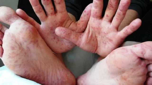 Комитет по здравоохранению требует созвать СНБО и объявить эпидемию кори