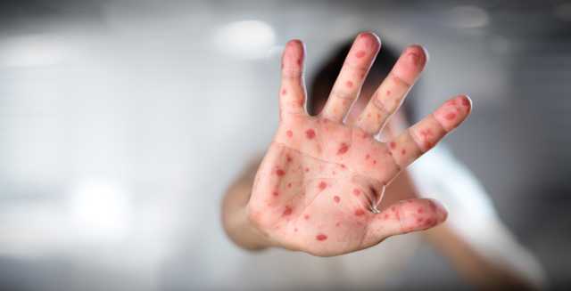 Україна стала першою серед країн Євросоюзу за кількістю хворих на кір