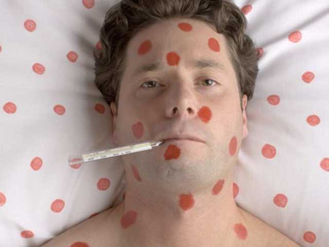 В Одесской области корью заболели 100 прихожан молитвенного дома