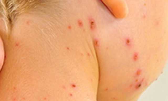 Принудительно прививать от кори всех детей подряд нельзя - врач