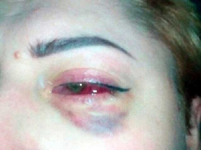 После татуажа век украинка ослепла на один глаз