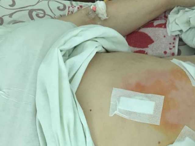 В Луцке из живота женщины удалили огромную мохнатую опухоль с зубами