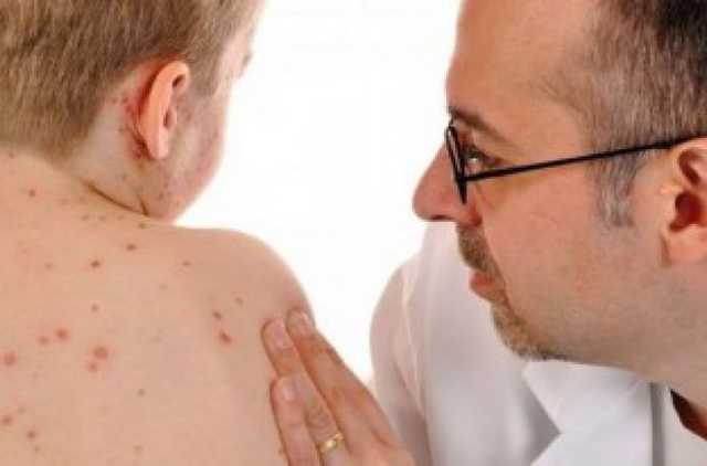 Украинцы «наградили» корью соседей, количество заболевших стремительно растет