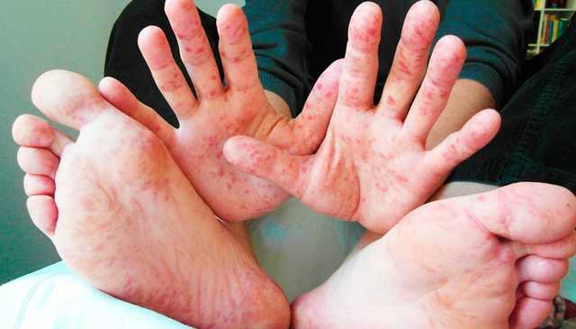 В Ровенской области от кори умерла девятилетняя девочка