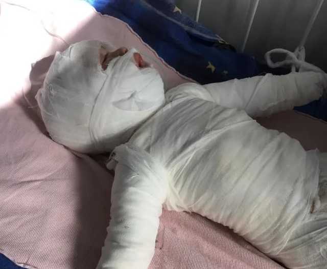 Под Одессой мама «сварила» малыша в кипятке