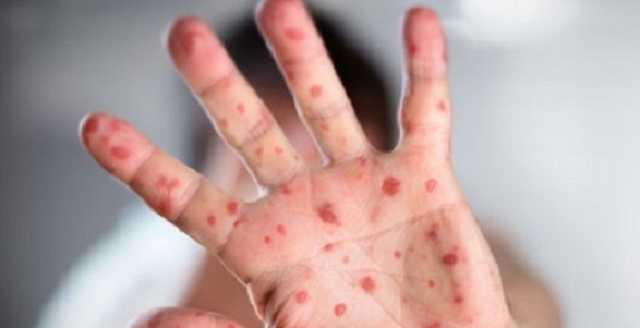 Смерть малыша от кори на Львовщине: стали известны подробности