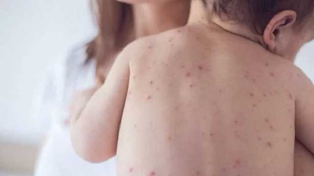 Корь в Украине «набирает обороты»: новые данные Минздрава