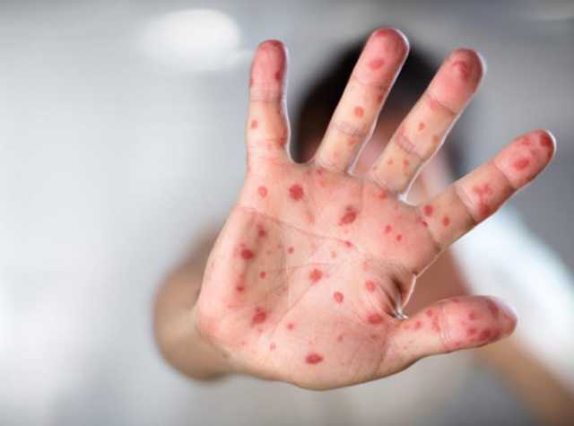 ВОЗ заявила о росте числа заболевших корью во всем мире