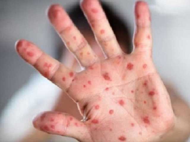 Украину обвинили в распространении кори в Израиле и США