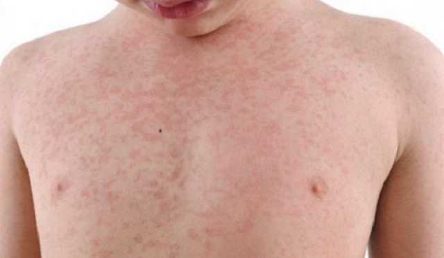 С начала года корью заболели почти 44 тысячи украинцев